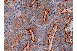 Detection of MUC1 in Human Endometrial cancer Tissue using Polyclonal Antibody to Mucin 1 (MUC1) (MUC1 Antikörper  (AA 1034-1151))