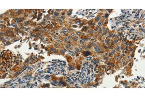 Immunohistochemistry of paraffin-embedded Human lung cancer using SERPINA9 Polyclonal Antibody at dilution of 1:60 (SERPINA9 Antikörper)