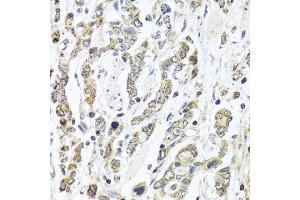 Immunohistochemistry of paraffin-embedded human gastric cancer using IFNL3 antibody (ABIN6293714) at dilution of 1:100 (40x lens). (IL28B Antikörper)
