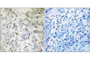 Immunohistochemistry analysis of paraffin-embedded human breast carcinoma tissue, using HCC1 Antibody. (RBM39 Antikörper  (AA 147-196))