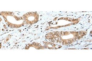 Immunohistochemistry of paraffin-embedded Human gastric cancer tissue using SPCS2 Polyclonal Antibody at dilution of 1:40(x200) (SPCS2 Antikörper)