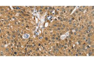 Immunohistochemistry of paraffin-embedded Human breast cancer using SORT1 Polyclonal Antibody at dilution of 1:35 (Sortilin 1 Antikörper)