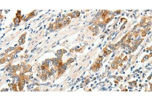 Immunohistochemistry of paraffin-embedded Human gastric cancer tissue using SCN9A Polyclonal Antibody at dilution 1:40 (SCN9A Antikörper)