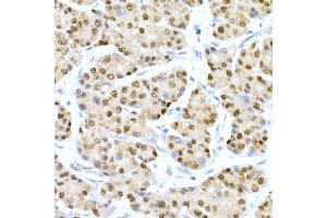 Immunohistochemistry of paraffin-embedded human liver cancer using HNF-4-alpha Rabbit mAb (ABIN7267621) at dilution of 1:150 (40x lens). (HNF4A Antikörper)