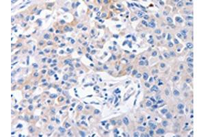 The image on the left is immunohistochemistry of paraffin-embedded Human lung cancer tissue using ABIN7192382(SLC10A1 Antibody) at dilution 1/31, on the right is treated with synthetic peptide. (SLC1A1 Antikörper)