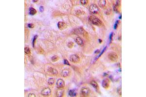 Immunohistochemical analysis of AKT (pS473) staining in human breast cancer formalin fixed paraffin embedded tissue section.