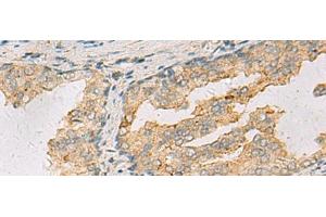 Immunohistochemistry of paraffin-embedded Human prost ate cancer tissue using ANXA13 Polyclonal Antibody at dilution of 1:105(x200) (Annexin A13 Antikörper)