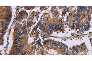 Immunohistochemistry of paraffin-embedded Human colon cancer using KRT31 Polyclonal Antibody at dilution of 1:30 (Keratin 31 Antikörper)