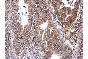 IHC-P Image Annexin VII antibody detects Annexin VII protein at cytosol on human gastric carcinoma by immunohistochemical analysis. (Annexin VII Antikörper)