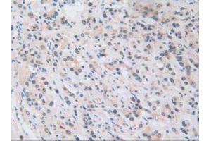 IHC-P analysis of Human Prostate Gland Cancer Tissue, with DAB staining. (NUP50 Antikörper  (AA 37-269))