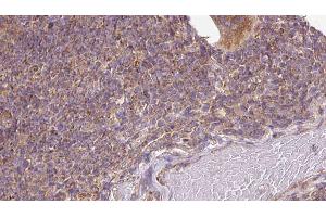 ABIN6273136 at 1/100 staining Human lymph cancer tissue by IHC-P. (DIAPH1 Antikörper)