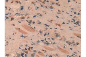 DAB staining on IHC-P; Samples: Human Prostate cancer Tissue (SPRY1 Antikörper  (AA 118-309))