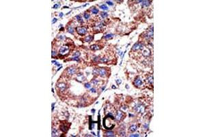 Formalin-fixed and paraffin-embedded human hepatocellular carcinoma tissue reacted with SQSTM1 polyclonal antibody  , which was peroxidase-conjugated to the secondary antibody, followed by DAB staining. (SQSTM1 Antikörper  (C-Term))