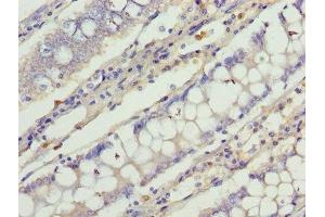 Immunohistochemistry of paraffin-embedded human colon cancer using ABIN7147039 at dilution of 1:100 (Cation Channel Sperm-Associated Protein Subunit epsilon (CATSPERE) (AA 601-832) Antikörper)