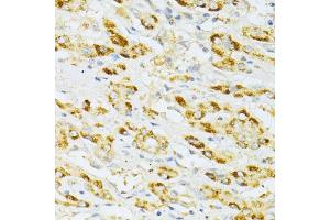 Immunohistochemistry of paraffin-embedded human liver cancer using FLT3 antibody (ABIN6134576, ABIN6140691, ABIN6140694 and ABIN6216061) at dilution of 1:100 (40x lens). (FLT3 Antikörper  (AA 650-750))