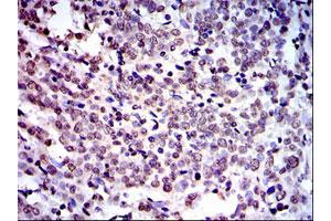 Immunohistochemical analysis of paraffin-embedded human cervical cancer tissues using NEDD8 monoclonal antibody, clone 1A7  with DAB staining. (NEDD8 Antikörper)