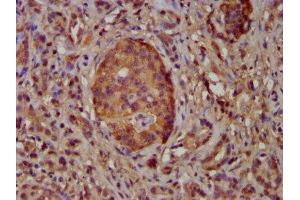IHC image of ABIN7169106 diluted at 1:100 and staining in paraffin-embedded human pancreatic cancer performed on a Leica BondTM system. (NEK5 Antikörper  (AA 372-468))