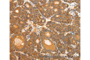 Immunohistochemistry of Human ovarian cancer using SCT Polyclonal Antibody at dilution of 1:40