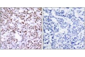 Immunohistochemistry analysis of paraffin-embedded human breast carcinoma, using Chk2 (Ab-68) Antibody. (CHEK2 Antikörper  (AA 35-84))