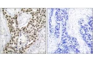 Immunohistochemistry analysis of paraffin-embedded human prostate carcinoma, using Androgen Receptor (Phospho-Ser213) Antibody. (Androgen Receptor Antikörper  (pSer213))