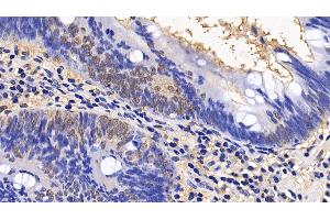 Detection of EIF4EBP1 in Human Colorectal cancer Tissue using Polyclonal Antibody to Eukaryotic Translation Initiation Factor 4E Binding Protein 1 (EIF4EBP1) (eIF4EBP1 Antikörper  (AA 2-118))