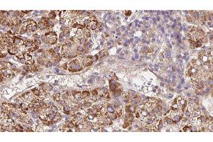 ABIN6279672 at 1/100 staining Human liver cancer tissue by IHC-P. (Plexin A2 Antikörper  (Internal Region))