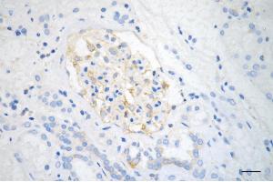 Immunohistochemistry was performed on paraffin-embedded human renal carcinoma using MYH9 antibody (ABIN7799520), 1:500).