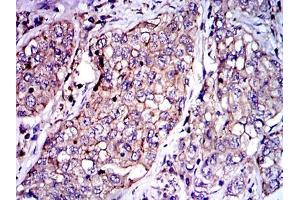 Immunohistochemical analysis of paraffin-embedded lung cancer tissues using SERPINE1 mouse mAb with DAB staining. (PAI1 Antikörper)