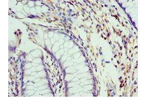 Immunohistochemistry of paraffin-embedded human colon cancer using ABIN7151101 at dilution of 1:100 (Pellino 1 Antikörper  (AA 1-250))
