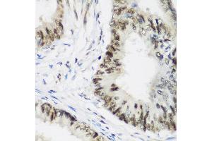 Immunohistochemistry of paraffin-embedded human colon carcinoma using AEBP2 antibody at dilution of 1:200 (40x lens). (AEBP2 Antikörper)