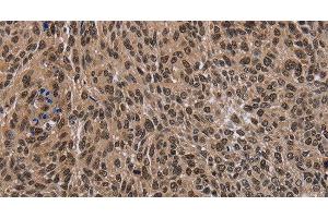 Immunohistochemistry of paraffin-embedded Human lung cancer tissue using DLX4 Polyclonal Antibody at dilution 1:50 (DLX4 Antikörper)