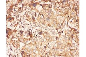 IHC-P: ALOX15 antibody testing of human breast cancer tissue (ALOX15 Antikörper  (AA 2-337))