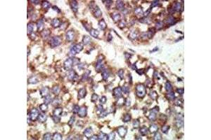 IHC analysis of FFPE human hepatocarcinoma tissue stained with the PAK2 antibody (PAK2 Antikörper  (AA 192-222))