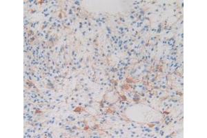 IHC-P analysis of Human Glioma Tissue, with DAB staining. (CRYAB Antikörper  (AA 1-175))