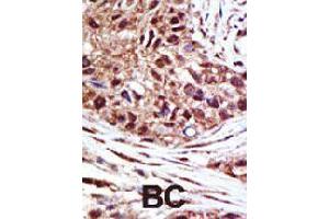 Formalin-fixed and paraffin-embedded human cancer tissue reacted with USP14 polyclonal antibody  , which was peroxidase-conjugated to the secondary antibody, followed by AEC staining . (USP14 Antikörper  (N-Term))