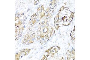 Immunohistochemistry of paraffin-embedded human prostate cancer using NRG4 antibody at dilution of 1:100 (40x lens). (Neuregulin 4 Antikörper)