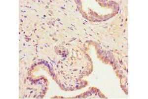 Immunohistochemistry of paraffin-embedded human prostate cancer using ABIN7168723 at dilution of 1:100 (SCAMP2 Antikörper  (AA 1-153))