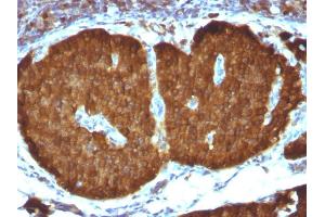 Formalin-fixed, paraffin-embedded human Pheochromocytoma stained with NSE gamma Monoclonal Antibody (ENO2/1375). (ENO2/NSE Antikörper  (AA 416-433))