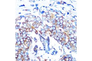Immunohistochemistry of paraffin-embedded human breast cancer using HD Rabbit mAb (ABIN7267711) at dilution of 1:100 (40x lens). (HDAC6 Antikörper)