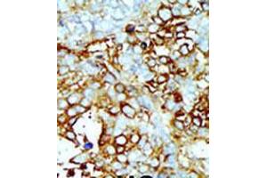 Formalin-fixed and paraffin-embedded human cancer tissue reacted with the primary antibody, which was peroxidase-conjugated to the secondary antibody, followed by AEC staining. (MAP4K2 Antikörper  (AA 288-319))