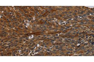 Immunohistochemistry of paraffin-embedded Human cervical cancer tissue using IVL Polyclonal Antibody at dilution 1:50 (Involucrin Antikörper)