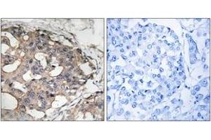 Immunohistochemistry analysis of paraffin-embedded human breast carcinoma tissue, using B-RAF (Ab-446) Antibody. (SNRPE Antikörper  (AA 411-460))