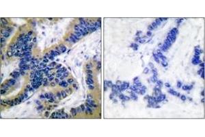 Immunohistochemistry analysis of paraffin-embedded human lung carcinoma tissue, using Caspase 6 (Cleaved-Asp162) Antibody. (Caspase 6 Antikörper  (Cleaved-Asp162))