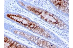 Formalin-fixed, paraffin-embedded human Colon Carcinoma stained with MUC4 Mouse Monoclonal Antibody (MUC4/3105). (MUC4 Antikörper  (AA 1730-1864))