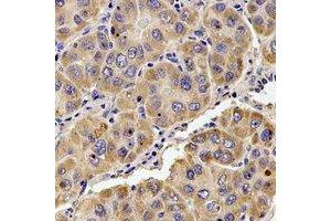 Immunohistochemical analysis of KIF1B staining in human liver cancer formalin fixed paraffin embedded tissue section.