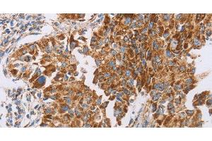 Immunohistochemistry of paraffin-embedded Human lung cancer tissue using GUCY1A3 Polyclonal Antibody at dilution 1:40 (GUCY1A1 Antikörper)