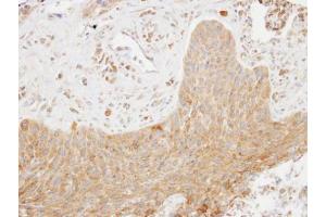 IHC-P Image Immunohistochemical analysis of paraffin-embedded human lung cancer, using SCAP2, antibody at 1:100 dilution. (SKAP2 Antikörper  (C-Term))