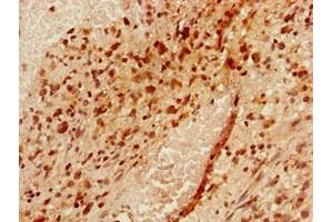 Immunohistochemistry of paraffin-embedded human glioma using ABIN7175954 at dilution of 1:100 (YAF2 Antikörper  (AA 1-204))
