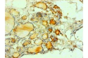 Immunohistochemical of paraffin-embedded human thyroid tissues using ABIN7162718 at dilution of 1:200 (CGRP Antikörper)