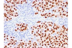Formalin-fixed, paraffin-embedded human melanoma stained with SOX10-Monospecific Recombinant Mouse Monoclonal Antibody (rSOX10/1074). (Rekombinanter SOX10 Antikörper  (AA 115-269))